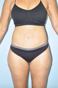 Paydar Plastic Surgery: Keyian Z Paydar, MD after — Newport Beach, CA