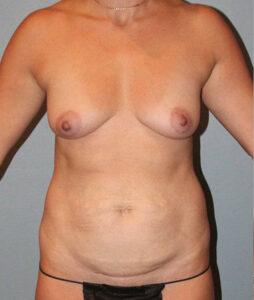 Mommy Makeover before at Paydar Plastic Surgery: Keyian Z Paydar, MD in Newport Beach, CA