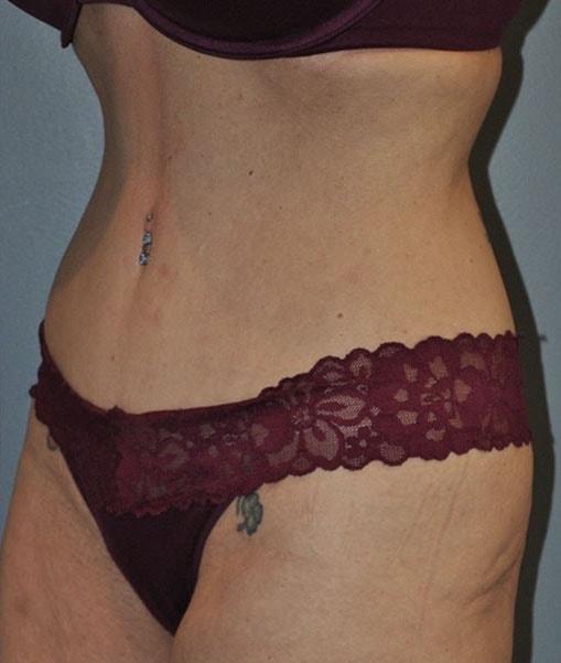 Paydar Plastic Surgery: Keyian Z Paydar, MD tummy tuck after — Newport Beach, CA