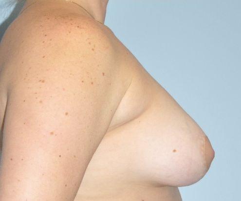 Paydar Plastic Surgery: Keyian Z Paydar, MD breast lift after — Newport Beach, CA
