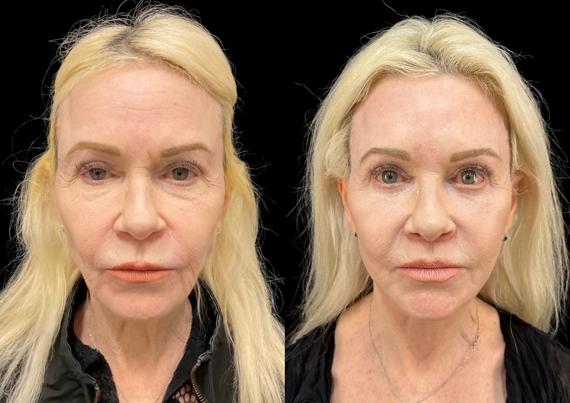 Robb Facial Plastic Surgery (Philip K. Robb Jr, MD) brow lift result — Alpharetta, GA
