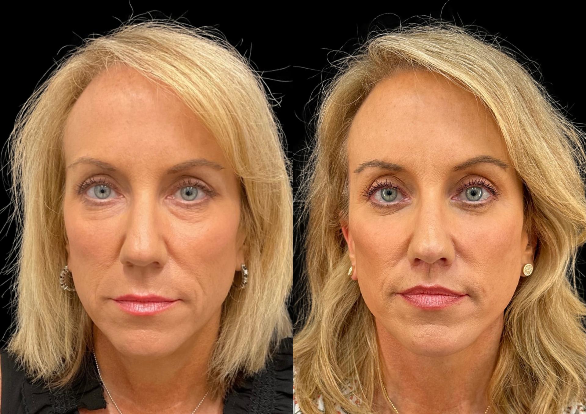 Robb Facial Plastic Surgery (Philip K. Robb Jr, MD) lip lift result — Alpharetta, GA