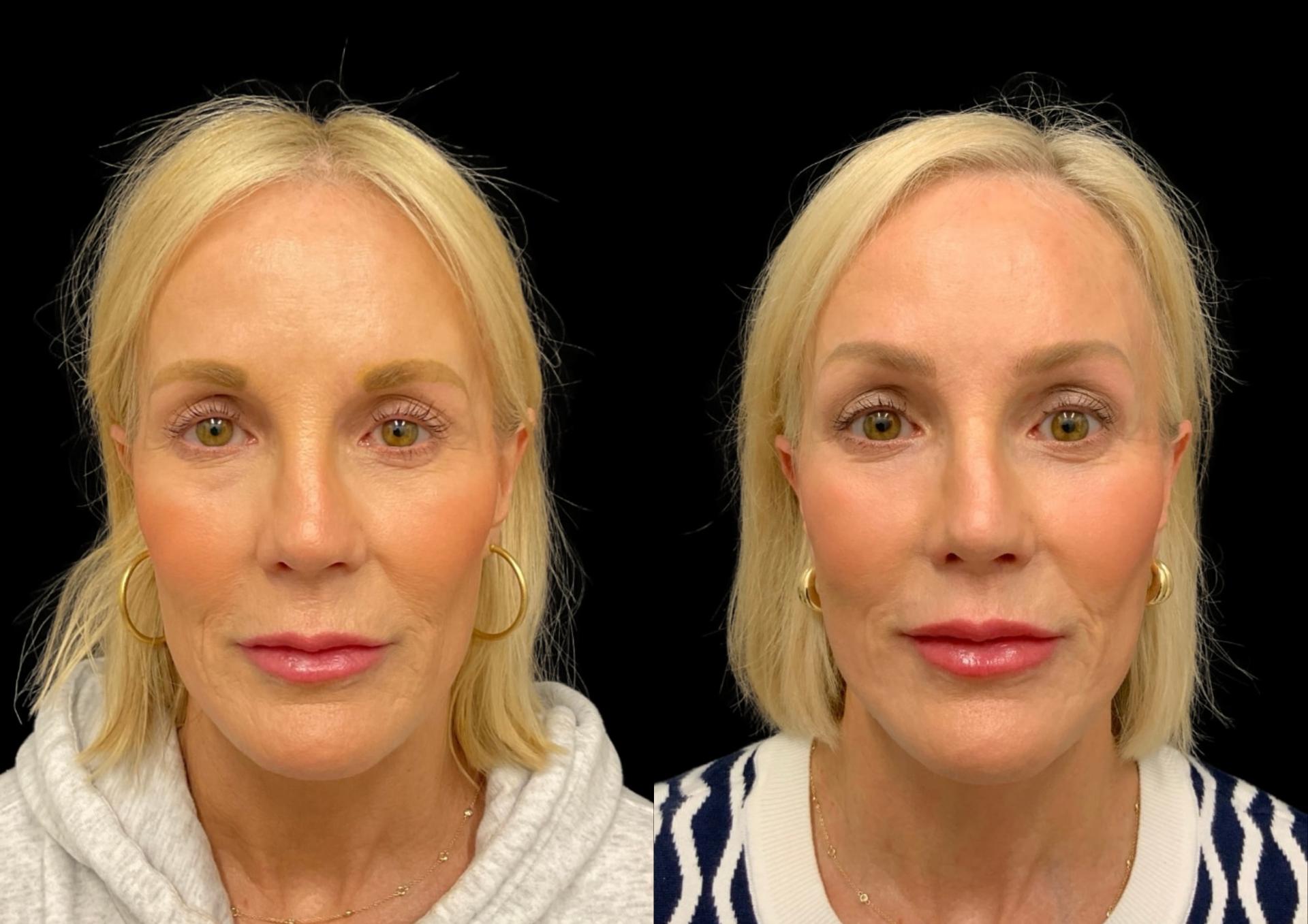 Robb Facial Plastic Surgery (Philip K. Robb Jr, MD) lip lift result — Alpharetta, GA