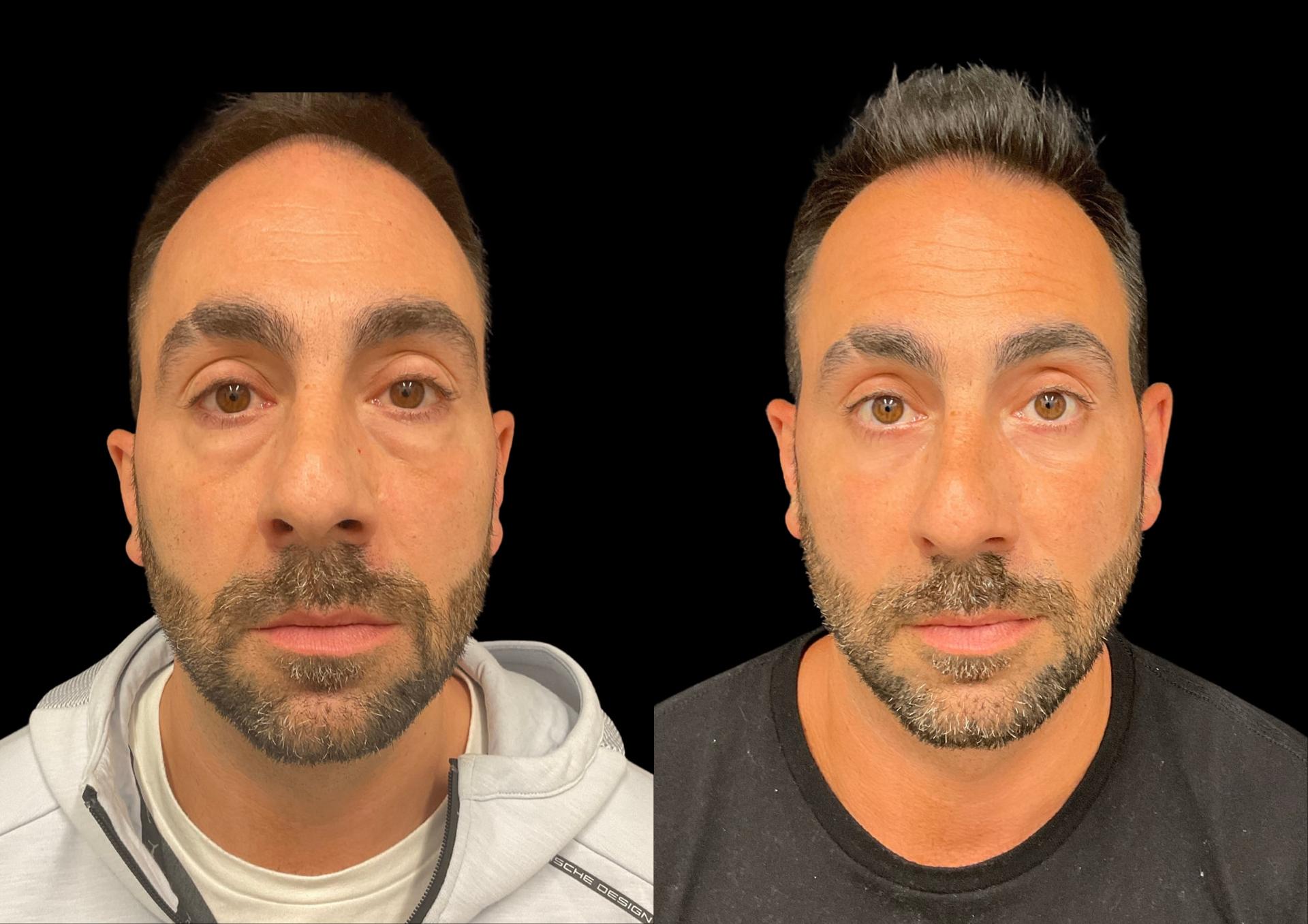 Robb Facial Plastic Surgery (Philip K. Robb Jr, MD) eyelid lift result — Alpharetta, GA