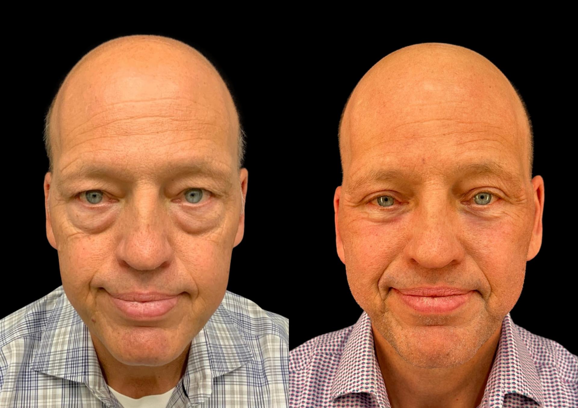 Robb Facial Plastic Surgery (Philip K. Robb Jr, MD) eyelid lift result — Alpharetta, GA