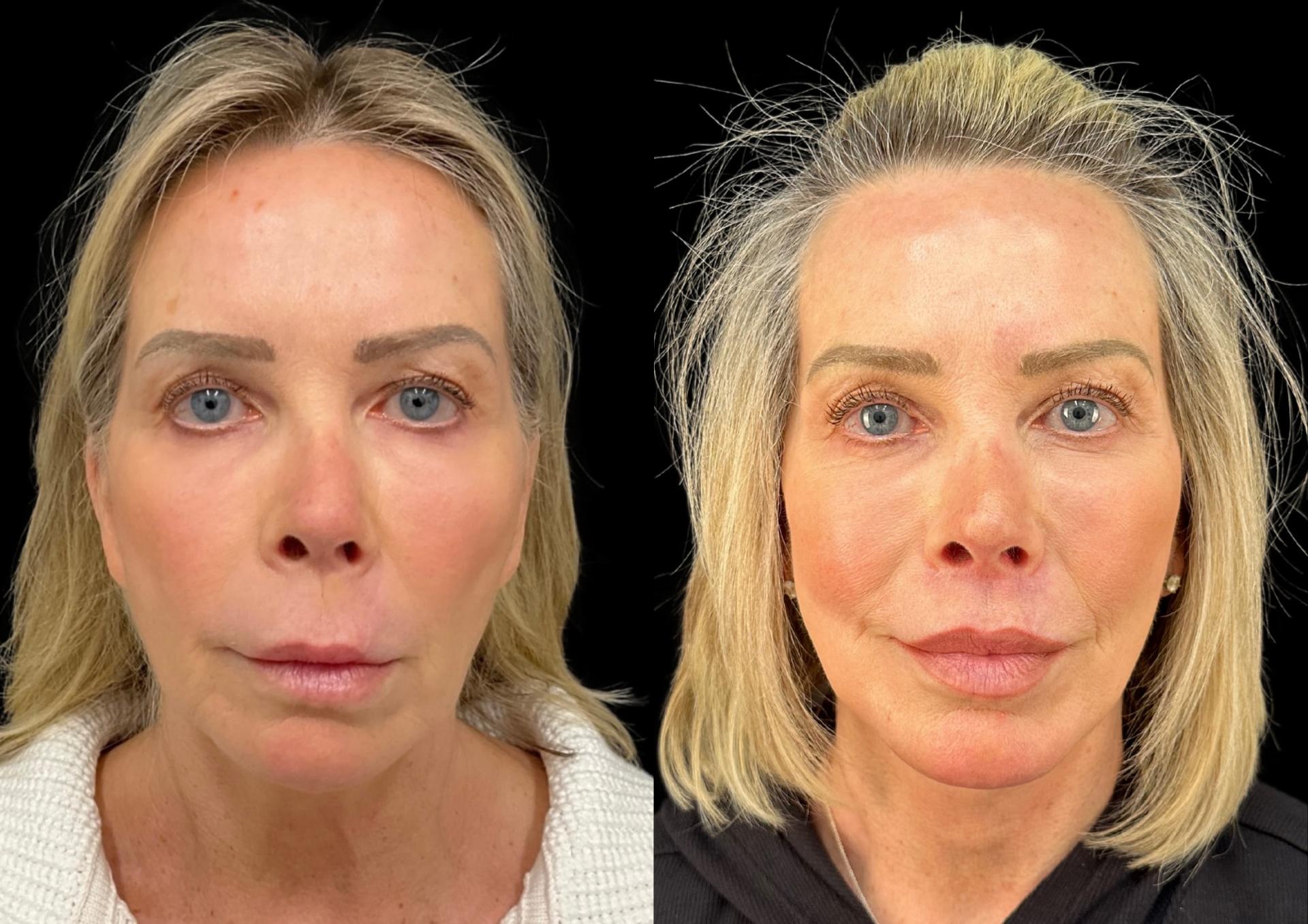 Robb Facial Plastic Surgery (Philip K. Robb Jr, MD) lip lift result — Alpharetta, GA
