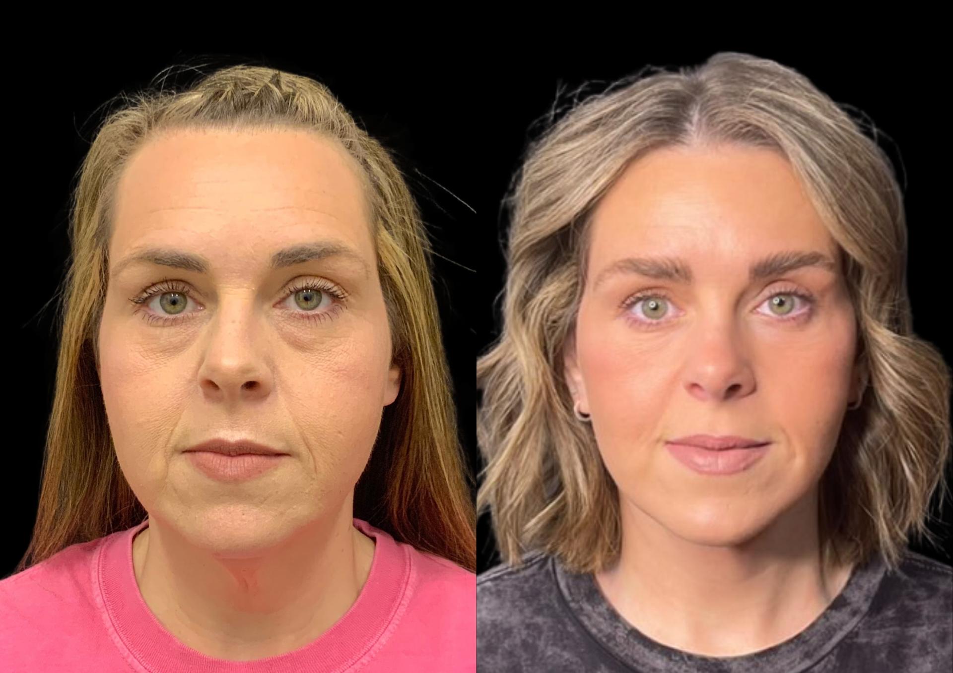 Robb Facial Plastic Surgery (Philip K. Robb Jr, MD) brow lift result — Alpharetta, GA
