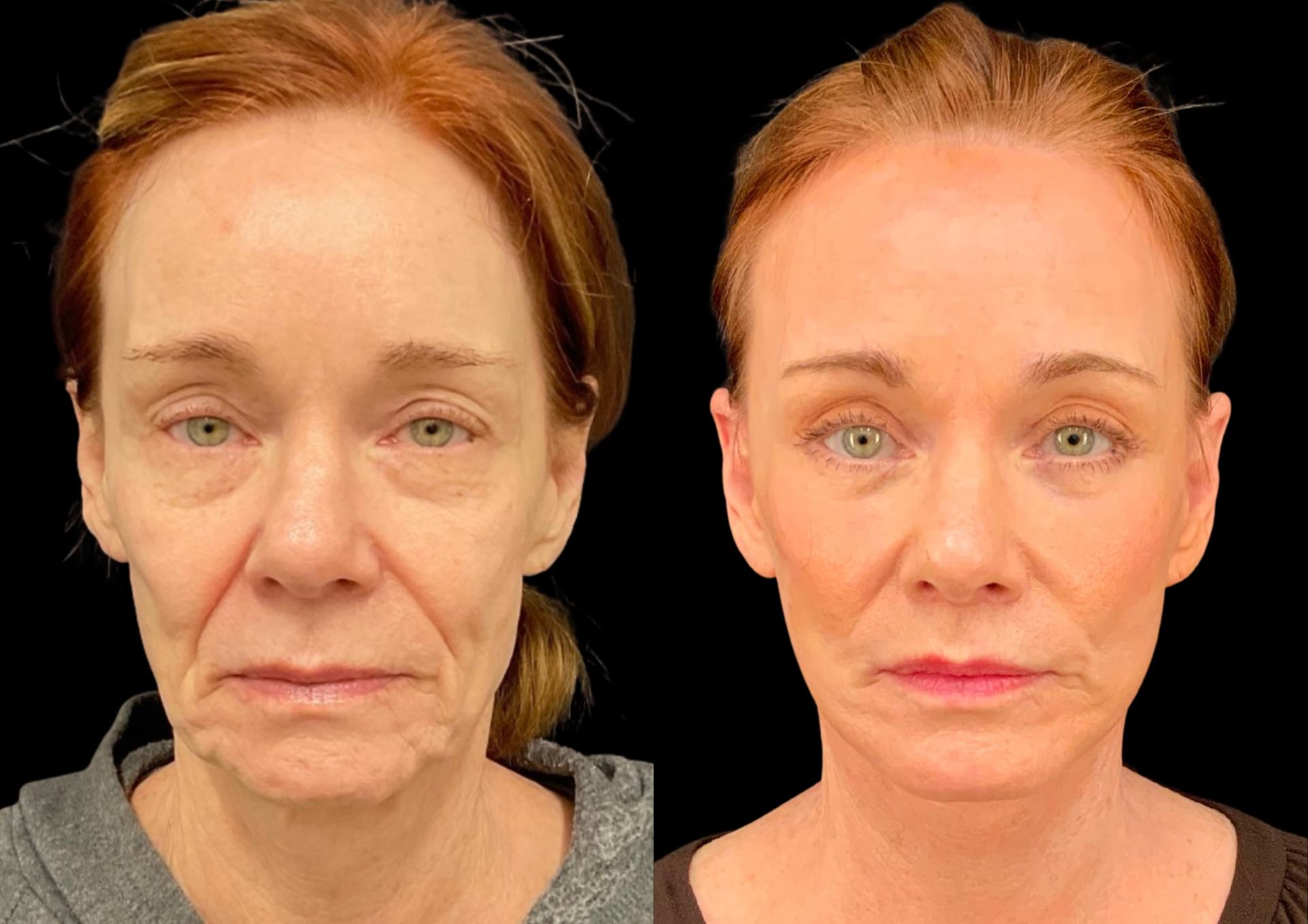 Robb Facial Plastic Surgery (Philip K. Robb Jr, MD) brow lift result — Alpharetta, GA