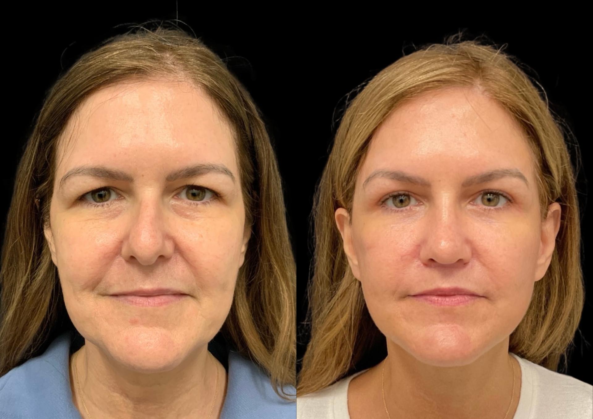 Robb Facial Plastic Surgery (Philip K. Robb Jr, MD) brow lift result — Alpharetta, GA