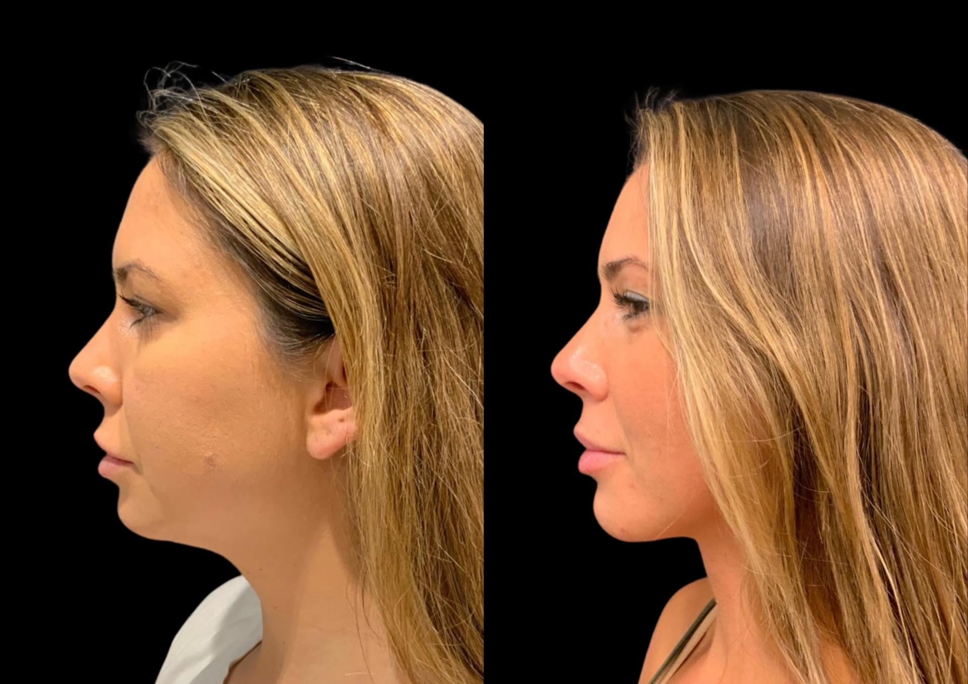 Robb Facial Plastic Surgery (Philip K. Robb Jr, MD) neck lift result — Alpharetta, GA
