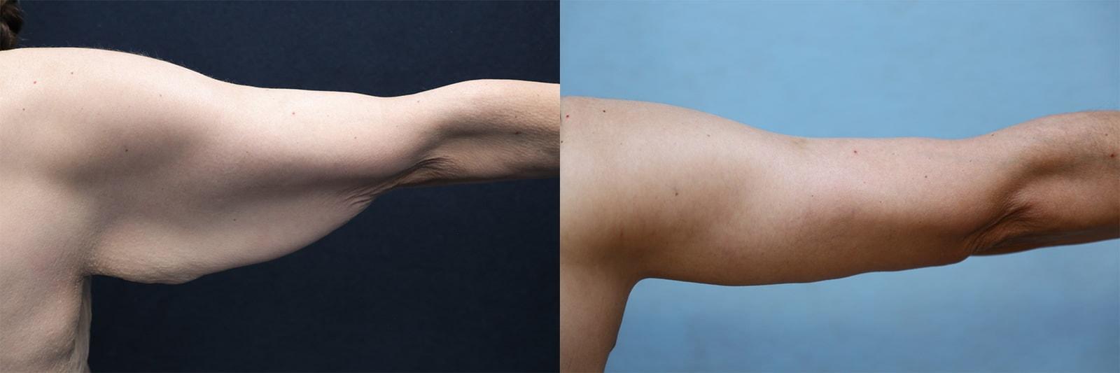 Dr. Michael Jazayeri - Plastic & Reconstructive Surgery arm lift result — Santa Ana, CA