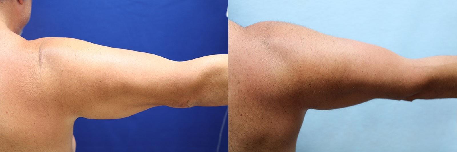 Dr. Michael Jazayeri - Plastic & Reconstructive Surgery arm lift result — Santa Ana, CA