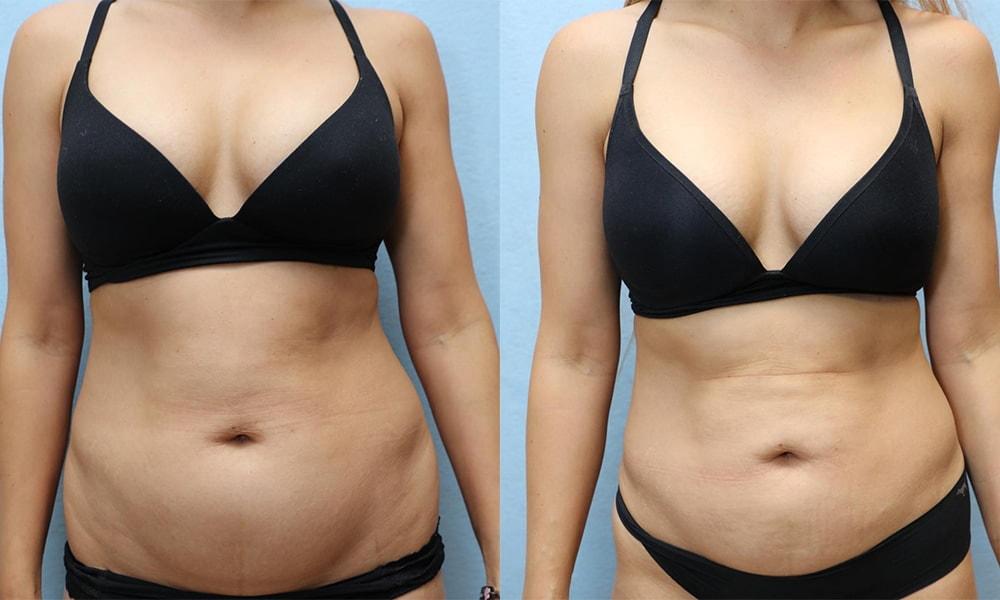 Dr. Michael Jazayeri - Plastic & Reconstructive Surgery liposuction result — Santa Ana, CA