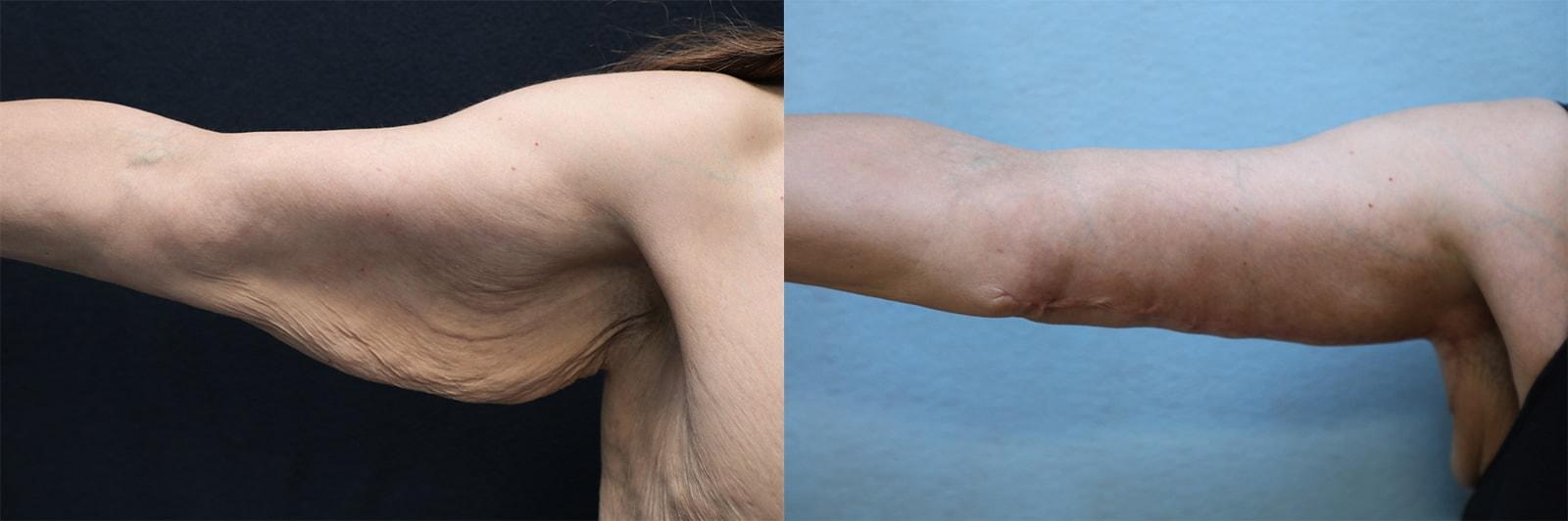 Dr. Michael Jazayeri - Plastic & Reconstructive Surgery arm lift result — Santa Ana, CA