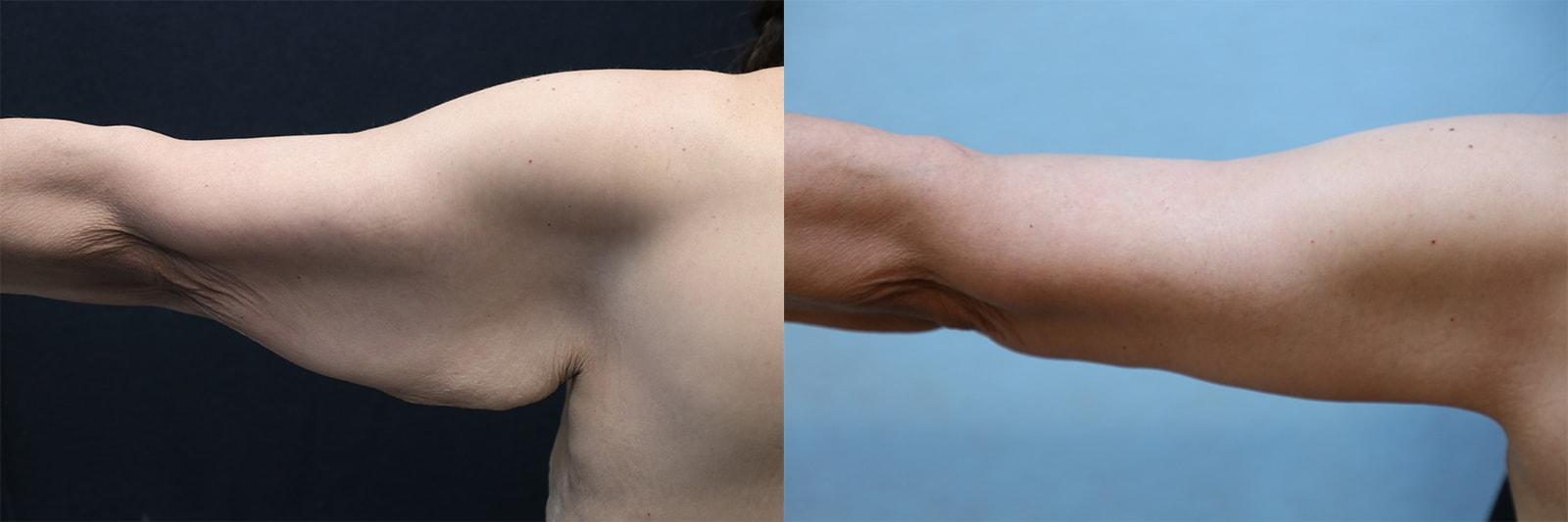 Dr. Michael Jazayeri - Plastic & Reconstructive Surgery arm lift result — Santa Ana, CA