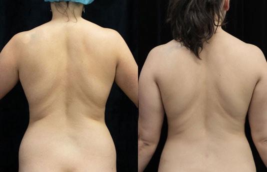 Dr. Michael Jazayeri - Plastic & Reconstructive Surgery liposuction result — Santa Ana, CA