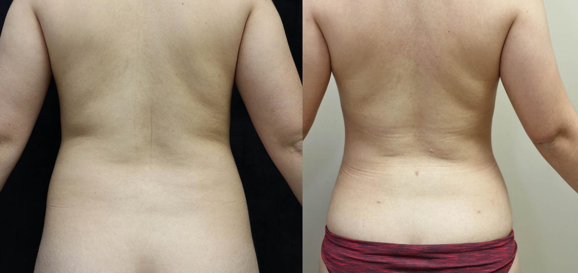 Dr. Michael Jazayeri - Plastic & Reconstructive Surgery liposuction result — Santa Ana, CA