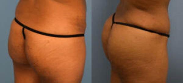 Ambay Plastic Surgery bbl result — Wesley Chapel, FL