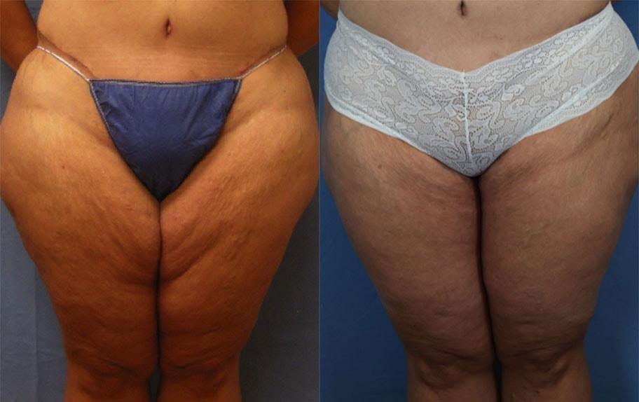 Ambay Plastic Surgery liposuction result — Wesley Chapel, FL