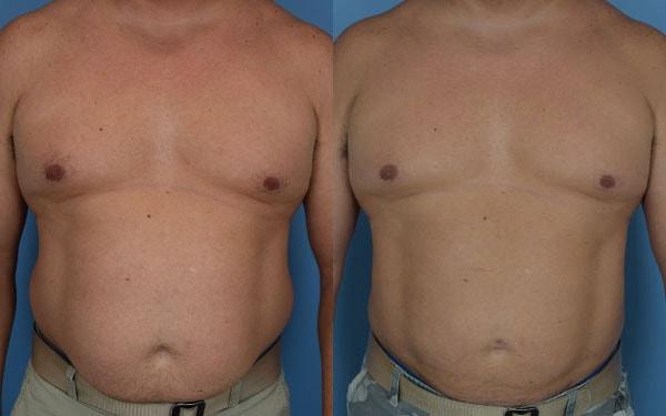 Ambay Plastic Surgery liposuction result — Wesley Chapel, FL