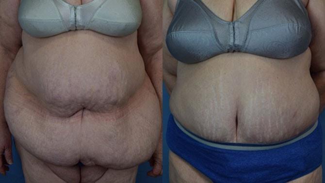 Ambay Plastic Surgery liposuction result — Wesley Chapel, FL