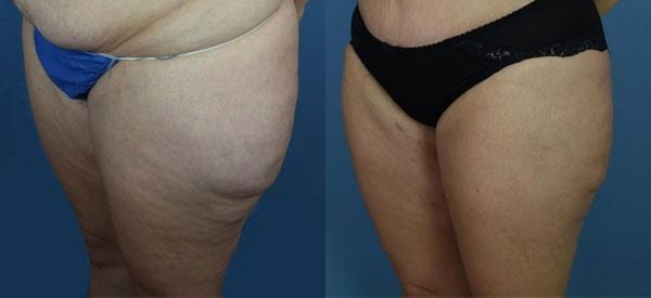 Ambay Plastic Surgery liposuction result — Wesley Chapel, FL