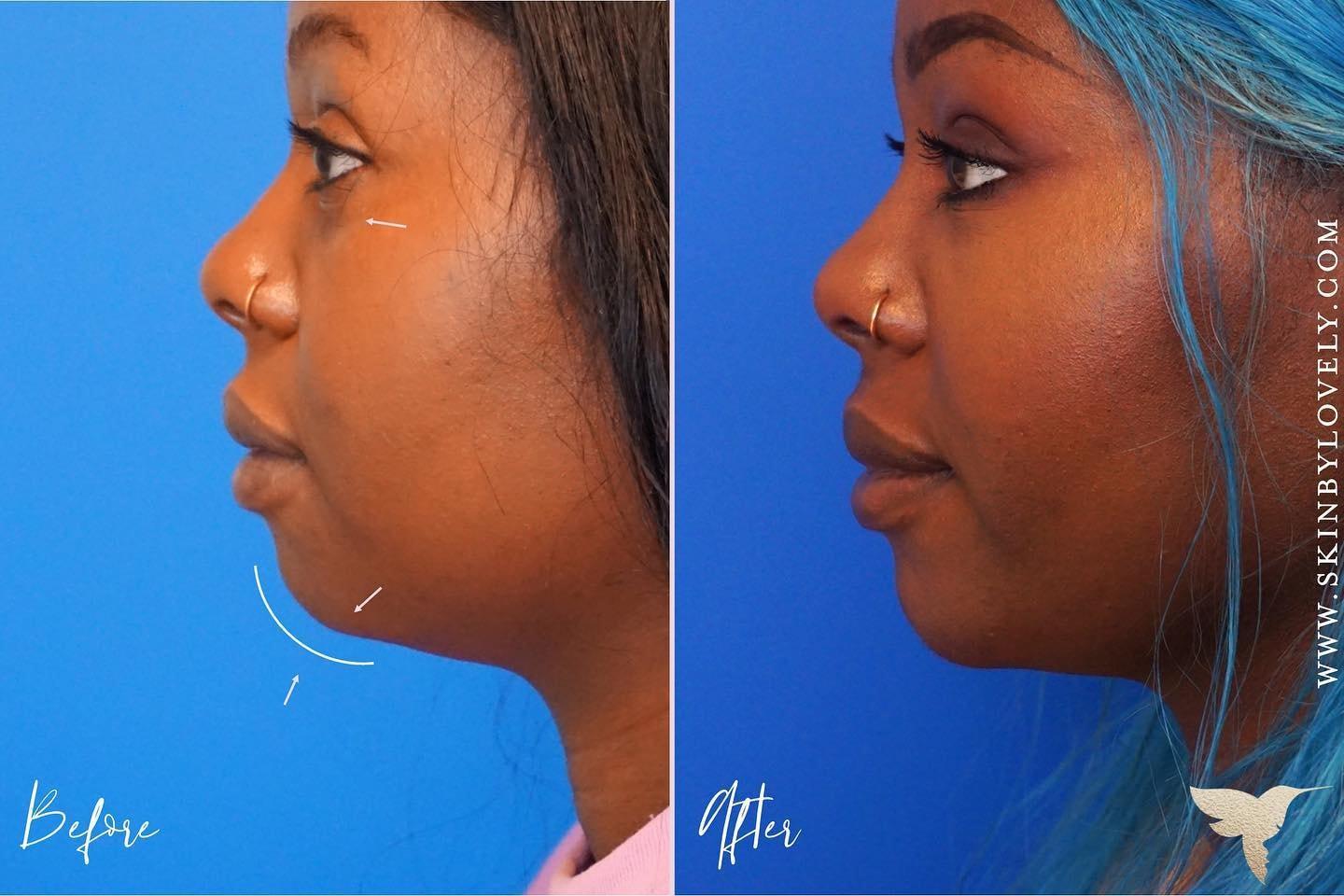 Skin by Lovely jawline filler result — Santa Monica, CA
