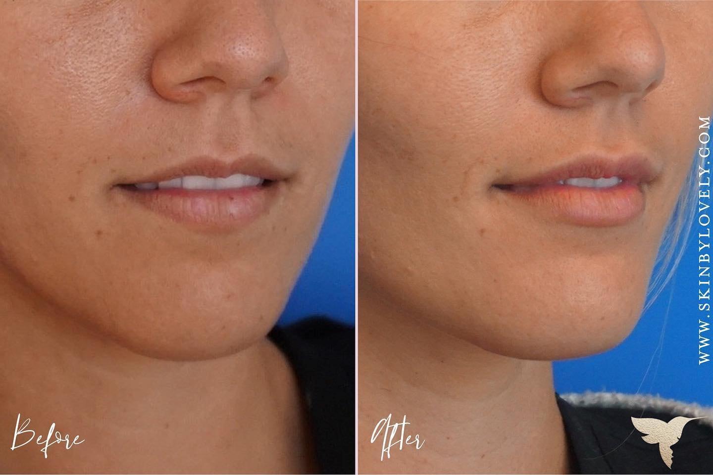 Skin by Lovely lip filler result — Santa Monica, CA