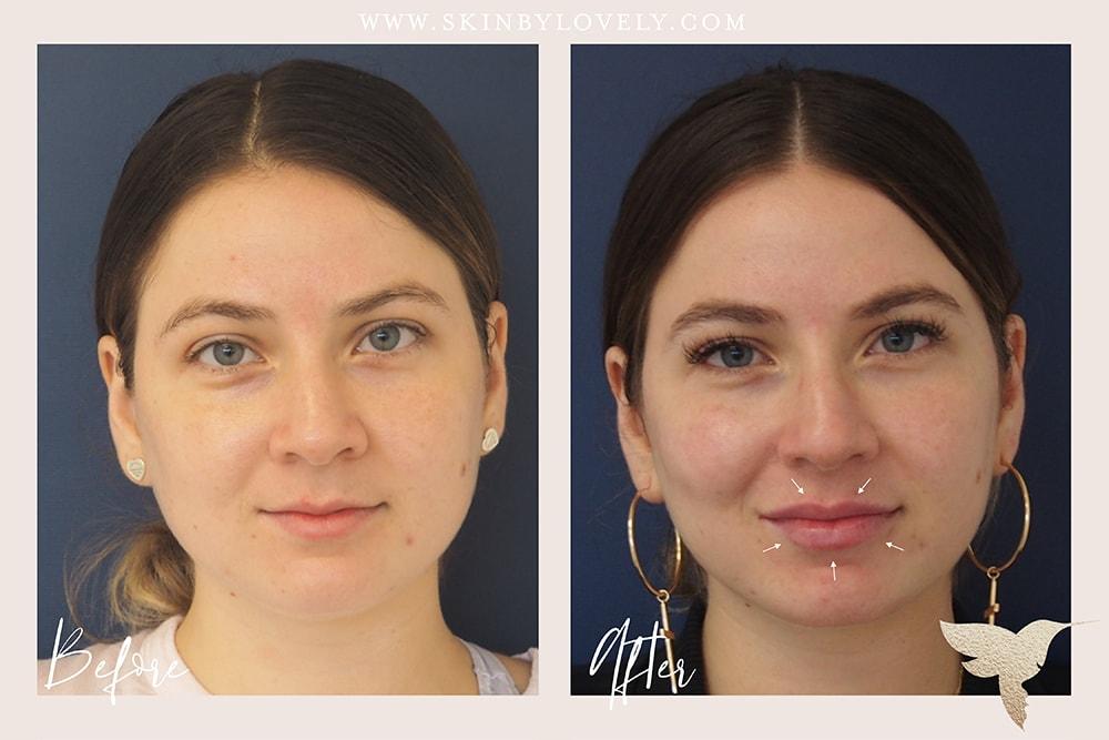 Skin by Lovely lip filler result — Santa Monica, CA
