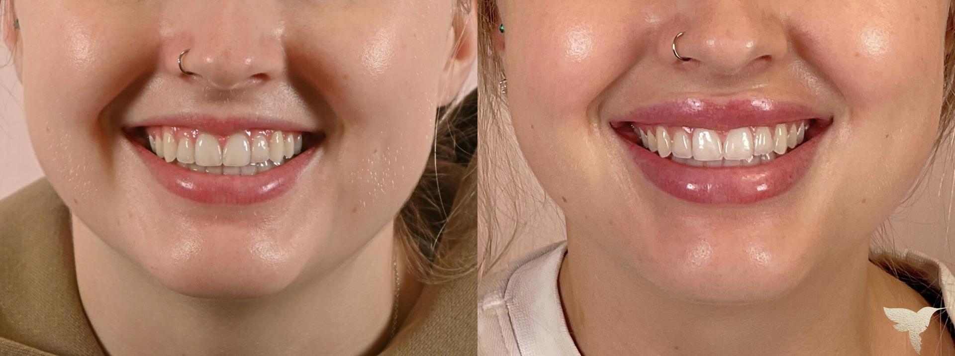 Skin by Lovely lip filler result — Santa Monica, CA