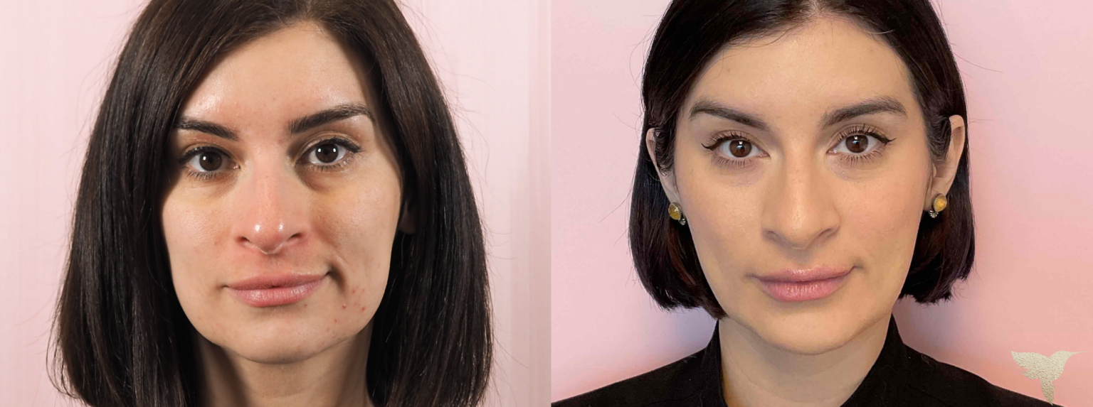 Skin by Lovely result — Santa Monica, CA
