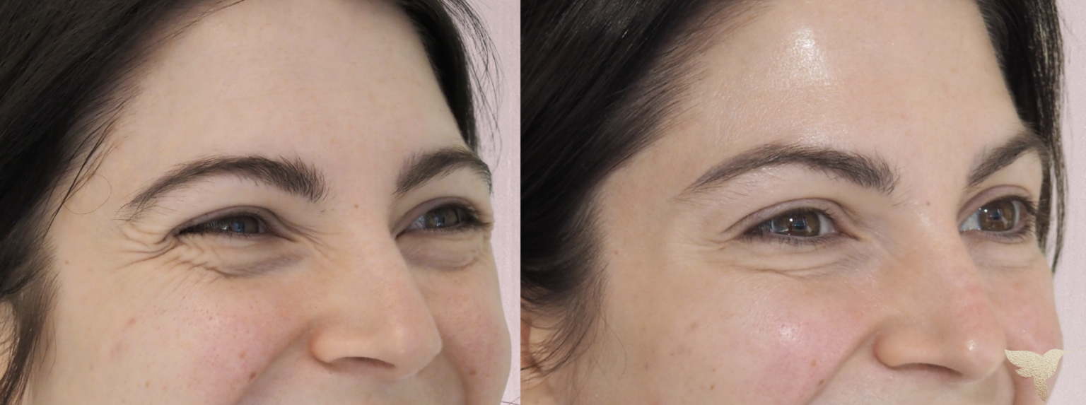 Skin by Lovely botox result — Santa Monica, CA