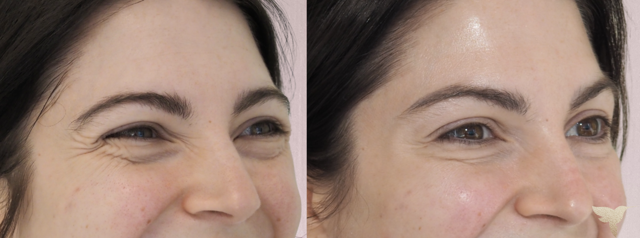 Botox result at Skin by Lovely in Santa Monica, CA