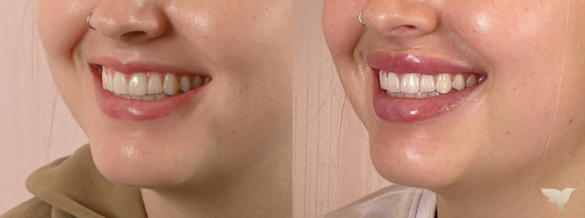 Skin by Lovely lip filler result — Santa Monica, CA