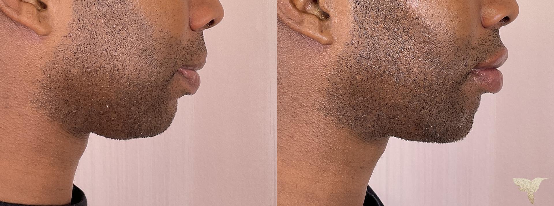 Skin by Lovely jawline filler result — Santa Monica, CA