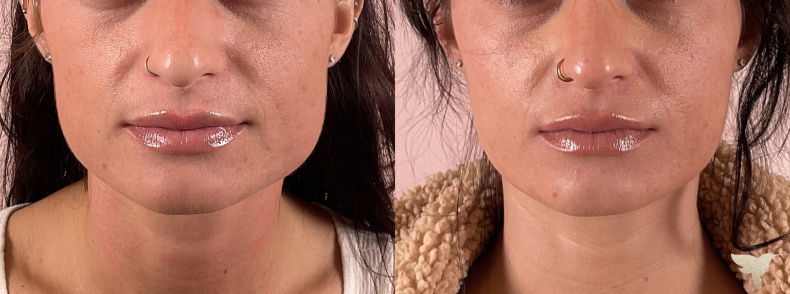Skin by Lovely botox result — Santa Monica, CA