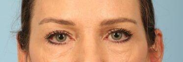 Kavali Plastic Surgery eyelid lift after — Sandy Springs, GA