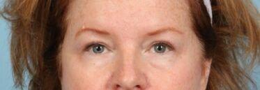 Kavali Plastic Surgery eyelid lift after — Sandy Springs, GA