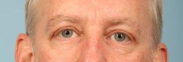 Kavali Plastic Surgery eyelid lift after — Sandy Springs, GA
