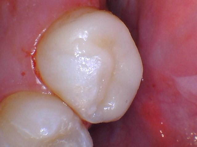 Boutique Family Dentistry smile makeover after — Irvine, CA