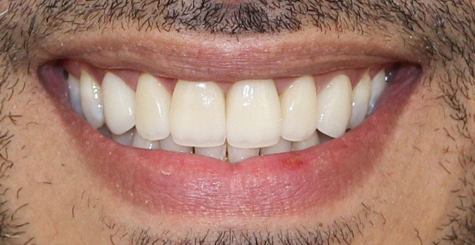 Boutique Family Dentistry smile makeover after — Irvine, CA