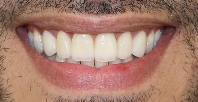 Smile Makeover after at Boutique Family Dentistry in Irvine, CA