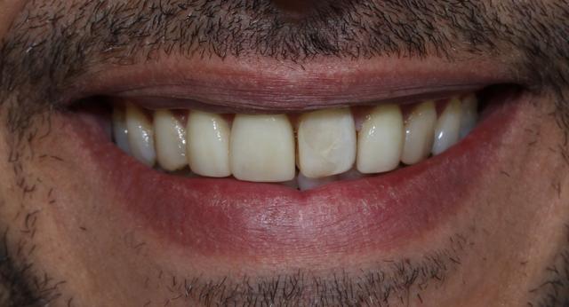 Smile Makeover before at Boutique Family Dentistry in Irvine, CA