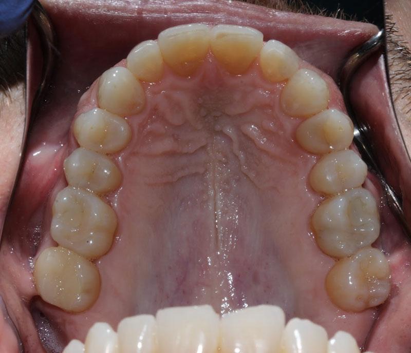 Boutique Family Dentistry smile makeover after — Irvine, CA