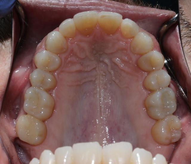 Smile Makeover after at Boutique Family Dentistry in Irvine, CA