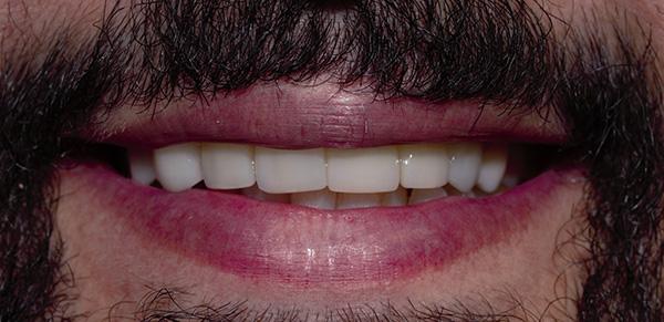 Boutique Family Dentistry smile makeover after — Irvine, CA