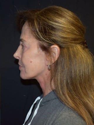 Robert Kessler MD a Medical Corp facelift after — Newport Beach, CA
