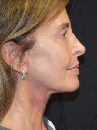 Robert Kessler MD a Medical Corp facelift after — Newport Beach, CA