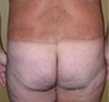 Robert Kessler MD a Medical Corp body lift after — Newport Beach, CA
