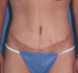 Tummy Tuck after at Robert Kessler MD a Medical Corp in Newport Beach, CA